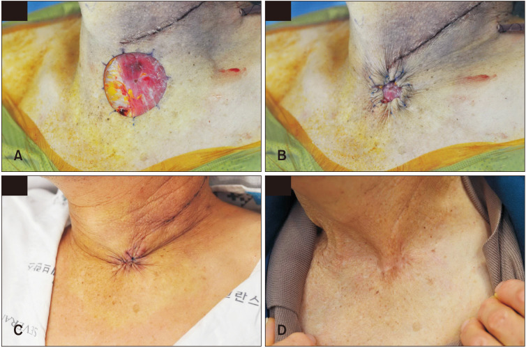 Various Applications of Purse-String Suture and Its Cosmetic Outcome in Cutaneous Surgical Defects.