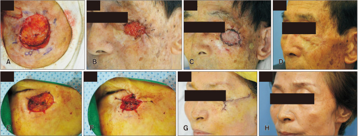 Various Applications of Purse-String Suture and Its Cosmetic Outcome in Cutaneous Surgical Defects.