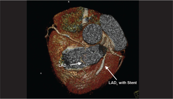 Dual Left Anterior Descending Artery: Clinical Overview and Interventional Management.