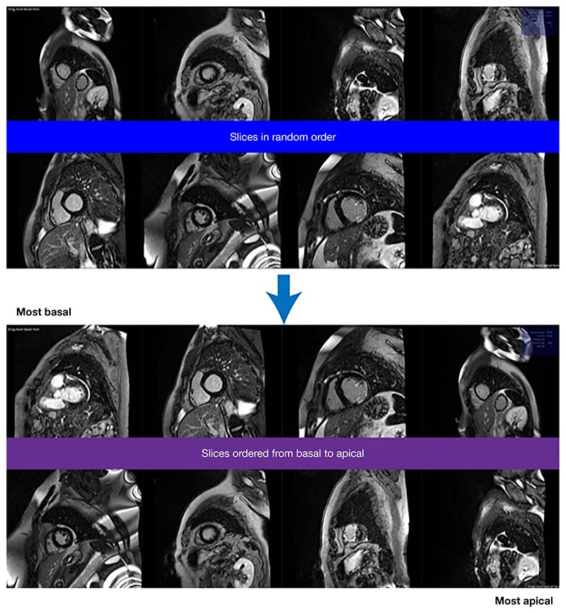 Efficient labelling for efficient deep learning: the benefit of a multiple-image-ranking method to generate high volume training data applied to ventricular slice level classification in cardiac MRI.