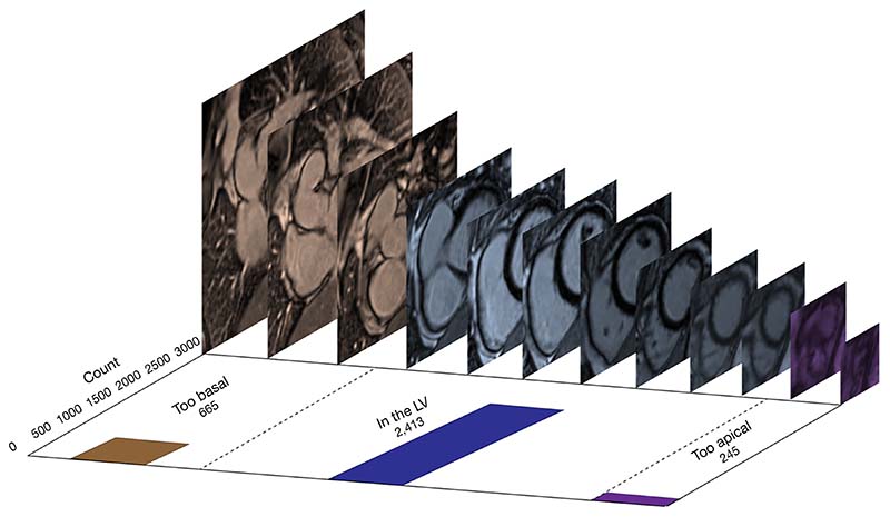 Efficient labelling for efficient deep learning: the benefit of a multiple-image-ranking method to generate high volume training data applied to ventricular slice level classification in cardiac MRI.