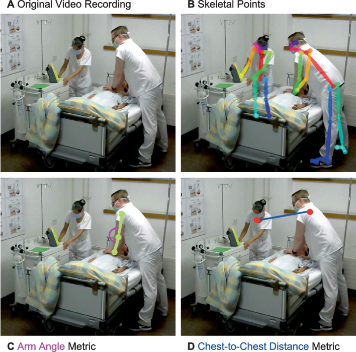 Data-driven resuscitation training using pose estimation.