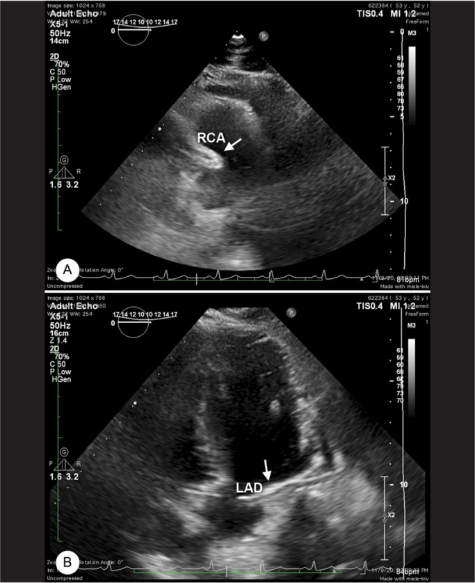 Dual Left Anterior Descending Artery: Clinical Overview and Interventional Management.