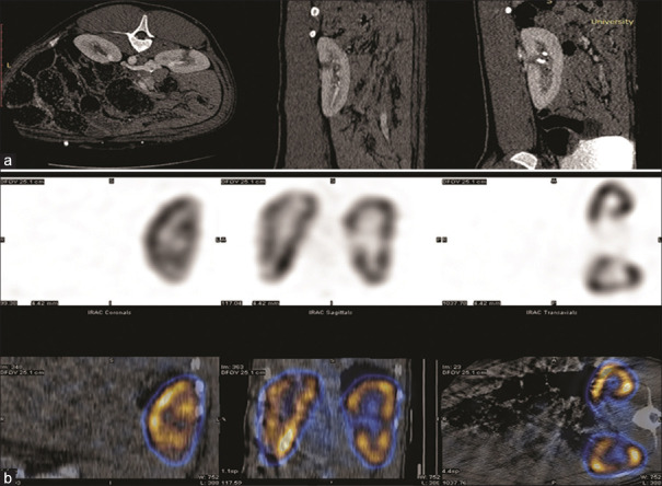 The effect of percutaneous tract dilation technique on renal parenchymal trauma: An experimental <i>in vivo</i> study on a porcine model.