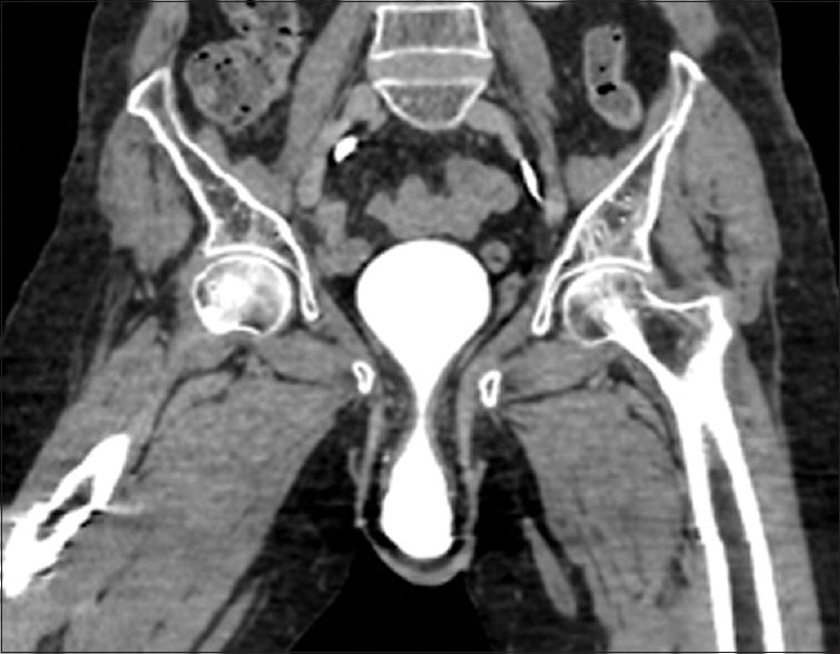 Hourglass appearance in cystocele with an impacted vesical calculus.