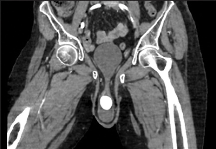 Hourglass appearance in cystocele with an impacted vesical calculus.