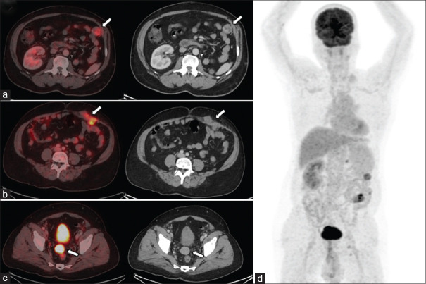 Recurrent Renal Cell Carcinoma Presenting as Port-Site Metastases, Detected on <sup>18</sup>F-Fluorodeoxyglucose Positron Emission Tomography-Computed Tomography.