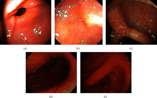 The Role of Benralizumab in Eosinophilic Immune Dysfunctions: A Case Report-Based Literature Review.