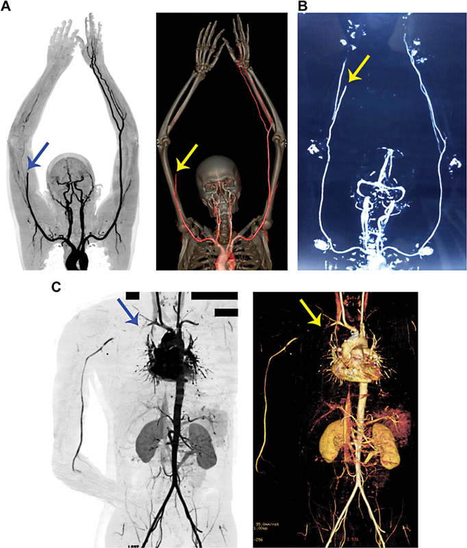 Peripheral Arterial Thrombosis following Russell's Viper Bites.