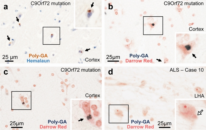 Loss of hypothalamic MCH decreases food intake in amyotrophic lateral sclerosis