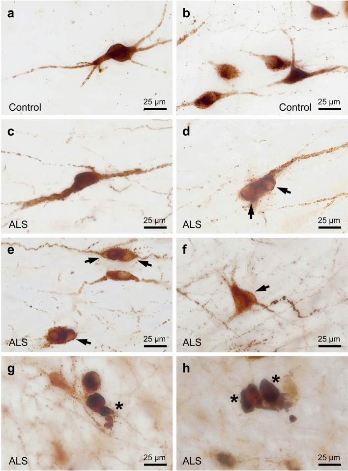 Loss of hypothalamic MCH decreases food intake in amyotrophic lateral sclerosis