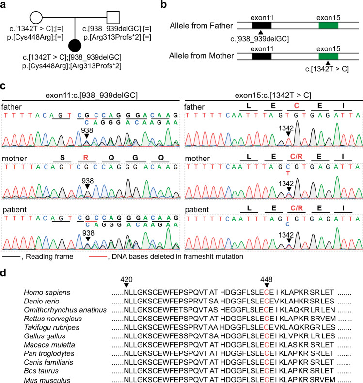 A novel variant in NBAS identified from an infant with fever-triggered recurrent acute liver failure disrupts the function of the gene.