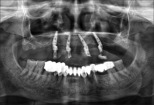 All-on-Four Case Rehabilitated with Fully Digitally Fabricated Prosthesis Milled from Graphene-Reinforced Poly Methyl Methacrylate Puck Using Indigenously Developed Intraoral and Extraoral Scanning Methods.