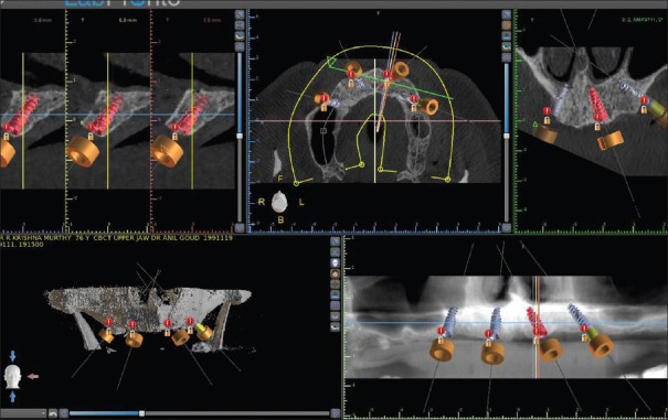 All-on-Four Case Rehabilitated with Fully Digitally Fabricated Prosthesis Milled from Graphene-Reinforced Poly Methyl Methacrylate Puck Using Indigenously Developed Intraoral and Extraoral Scanning Methods.