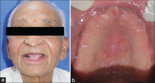 All-on-Four Case Rehabilitated with Fully Digitally Fabricated Prosthesis Milled from Graphene-Reinforced Poly Methyl Methacrylate Puck Using Indigenously Developed Intraoral and Extraoral Scanning Methods.