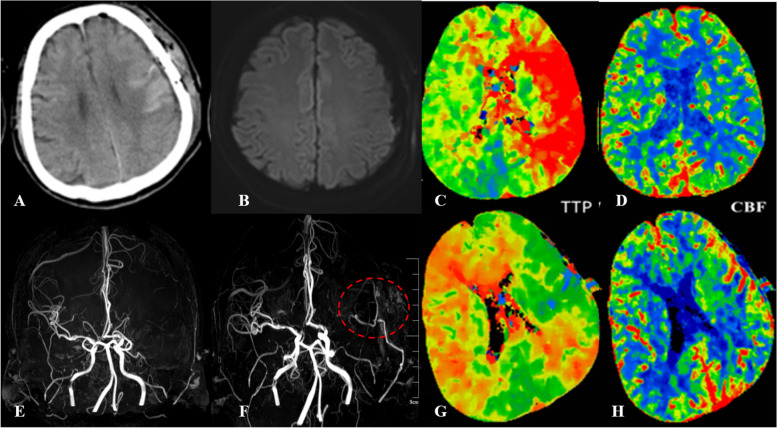 Risk factors of postoperative cerebral hyperperfusion syndrome and its relationship with clinical prognosis in adult patients with moyamoya disease.