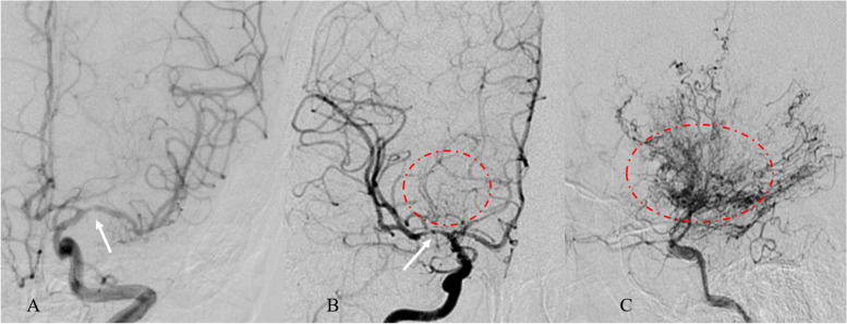 Risk factors of postoperative cerebral hyperperfusion syndrome and its relationship with clinical prognosis in adult patients with moyamoya disease.