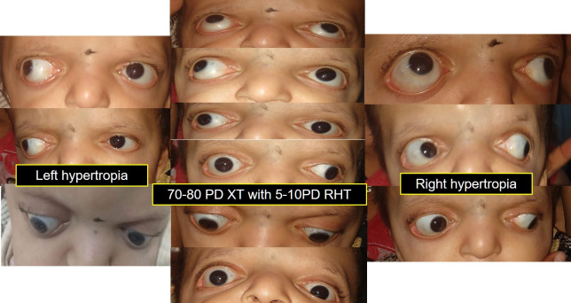 Apert Syndrome - caveats of squint management.