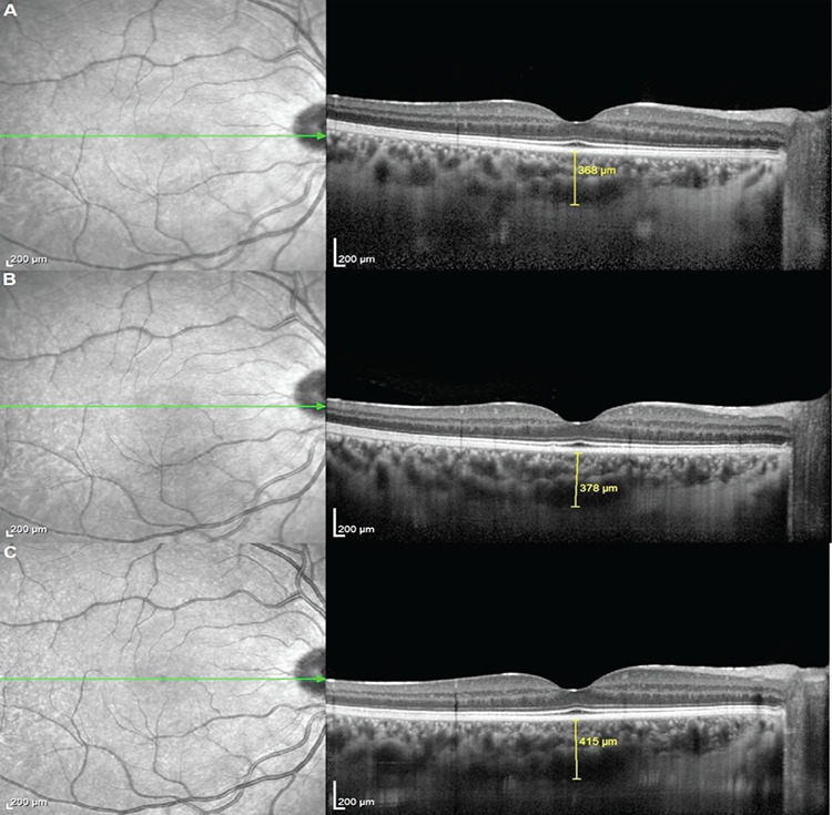 Choroidal Vascularity Index and Choroidal Thickness Changes Following Renal Transplantation.