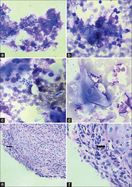 Utility of Indigenous Cytology Technique in the Diagnosis of Oral Cavity Lesions using Normal Saline as a Processing Fluid: A Comparative Study.