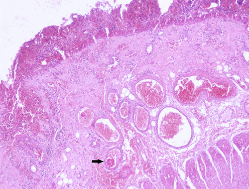 The Spectrum of Digestive Tract Histopathologic Findings in the Setting of Severe Acute Respiratory Syndrome Coronavirus-2 Infection: What Pathologists Need to Know.