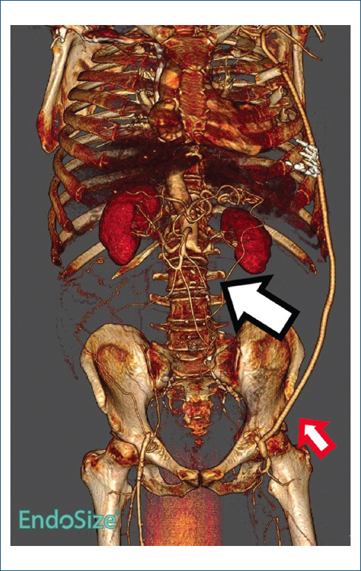 [Tako-tsubo syndrome in a patient with acute arterial ischemia of the lower limbs].