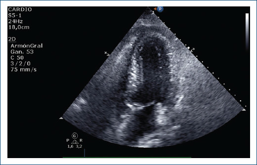 [Tako-tsubo syndrome in a patient with acute arterial ischemia of the lower limbs].