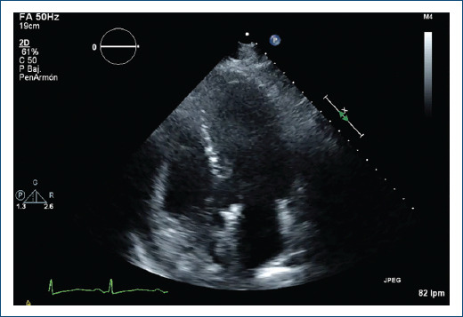 [Tako-tsubo syndrome in a patient with acute arterial ischemia of the lower limbs].