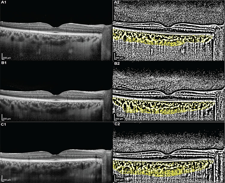 Choroidal Vascularity Index and Choroidal Thickness Changes Following Renal Transplantation.