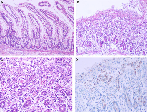 The Spectrum of Digestive Tract Histopathologic Findings in the Setting of Severe Acute Respiratory Syndrome Coronavirus-2 Infection: What Pathologists Need to Know.