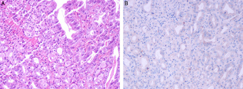 The Spectrum of Digestive Tract Histopathologic Findings in the Setting of Severe Acute Respiratory Syndrome Coronavirus-2 Infection: What Pathologists Need to Know.