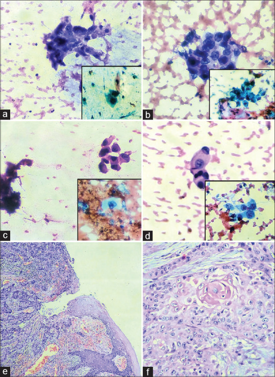 Utility of Indigenous Cytology Technique in the Diagnosis of Oral Cavity Lesions using Normal Saline as a Processing Fluid: A Comparative Study.