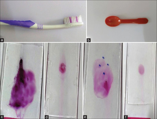 Utility of Indigenous Cytology Technique in the Diagnosis of Oral Cavity Lesions using Normal Saline as a Processing Fluid: A Comparative Study.