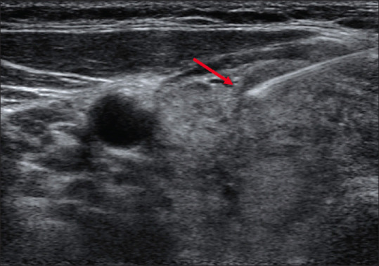 Performance of European Thyroid Imaging Reporting and Data System in Stratifying Malignancy Risk of Thyroid Nodules: A Prospective Study.