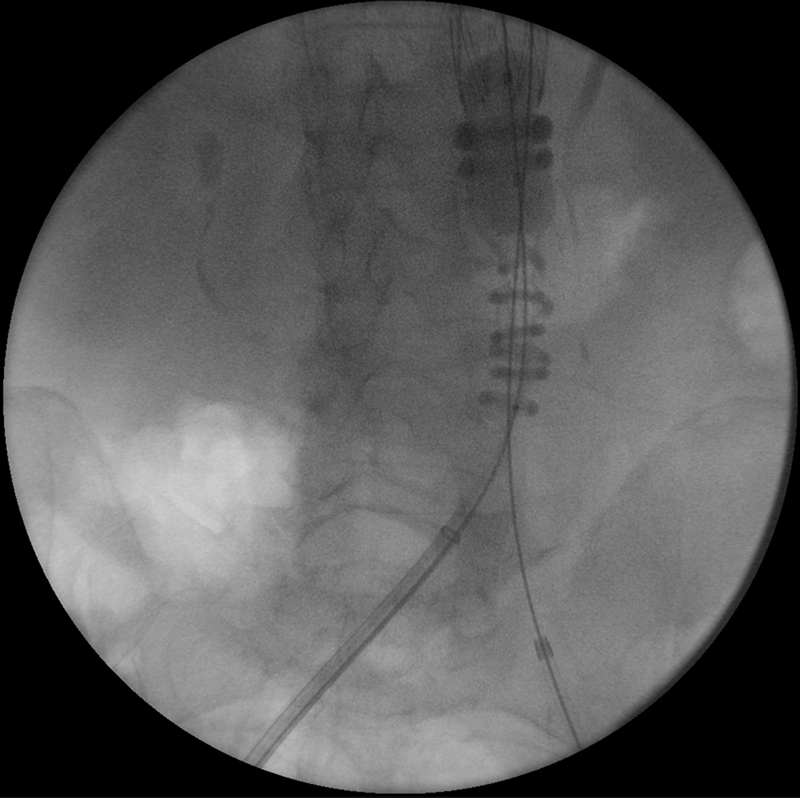 Myasthenia Gravis and Abdominal Aortic Aneurysm: A Rare Combination.