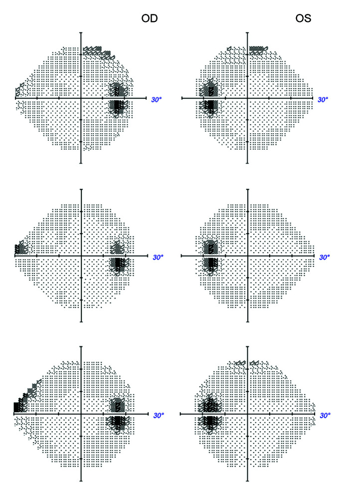 New-onset Glaucoma Following Moderna COVID-19 Vaccination.