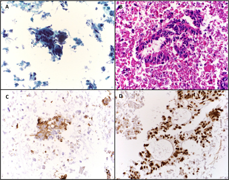 Colorectal cancer metastases in thyroid: case report and literature review.