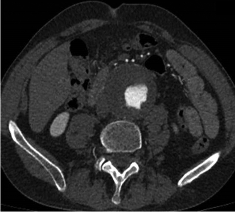 Myasthenia Gravis and Abdominal Aortic Aneurysm: A Rare Combination.