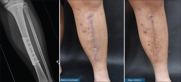 Orthopedic implant hypersensitivity: Characterization of clinical presentation and effects of photobiomodulation therapy.