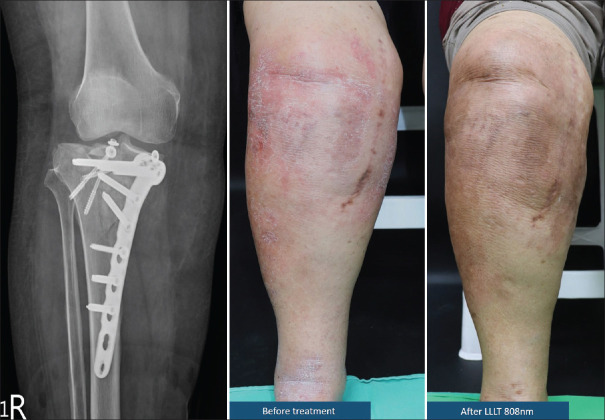 Orthopedic implant hypersensitivity: Characterization of clinical presentation and effects of photobiomodulation therapy.