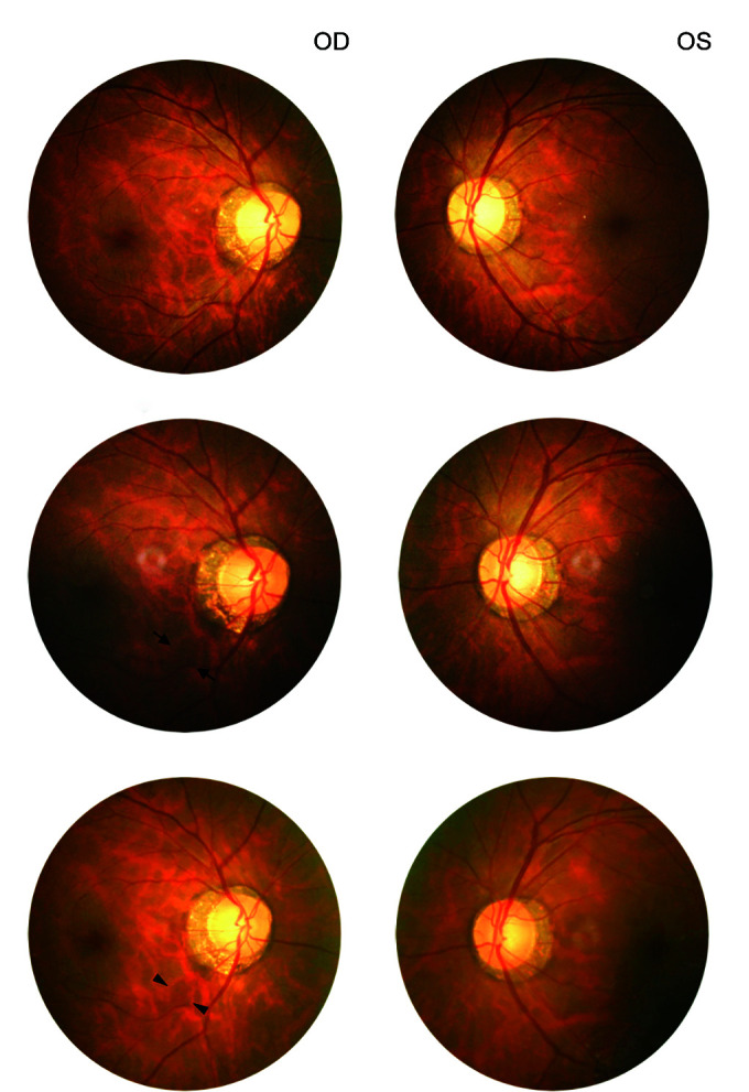 New-onset Glaucoma Following Moderna COVID-19 Vaccination.