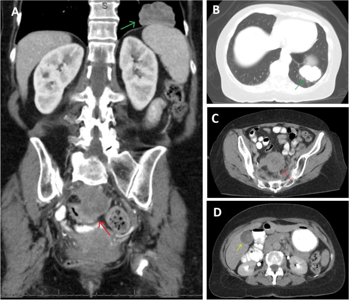 Colorectal cancer metastases in thyroid: case report and literature review.