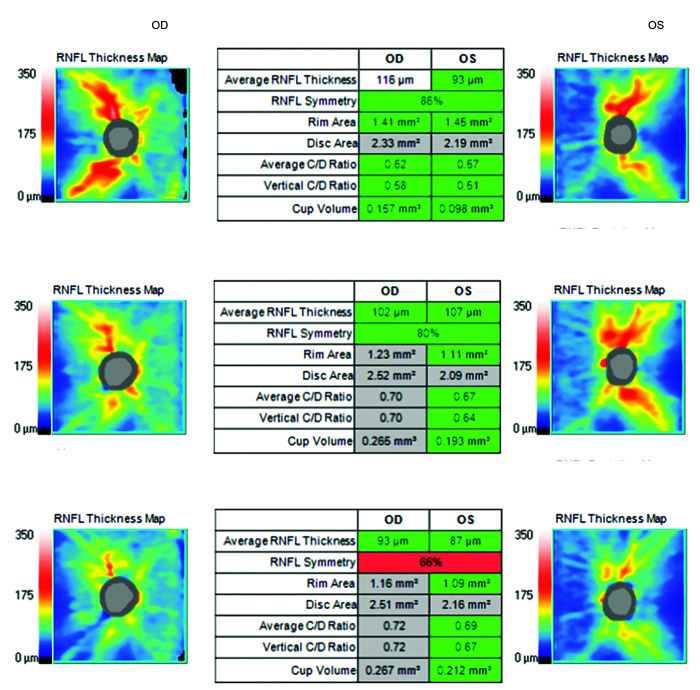 New-onset Glaucoma Following Moderna COVID-19 Vaccination.