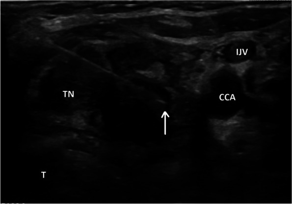 Colorectal cancer metastases in thyroid: case report and literature review.