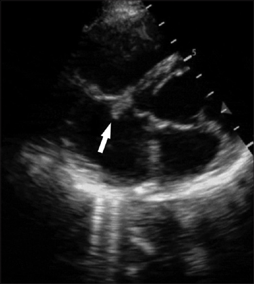 Native tricuspid valve endocarditis presenting as pyrexia of unknown origin.