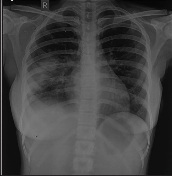 Native tricuspid valve endocarditis presenting as pyrexia of unknown origin.