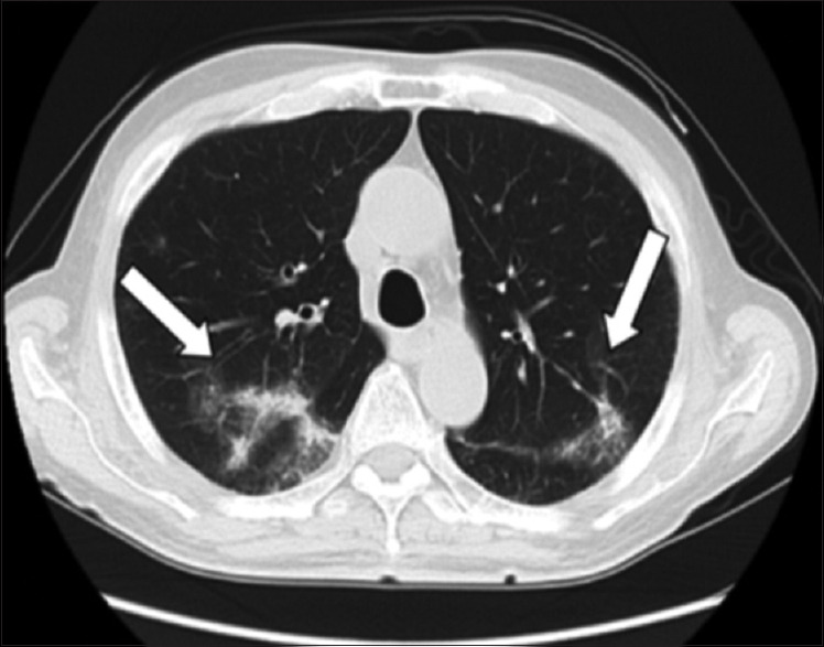 Native tricuspid valve endocarditis presenting as pyrexia of unknown origin.