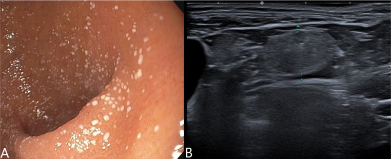 [Whipple's disease with multiple presentation in a rheumatologic patient].