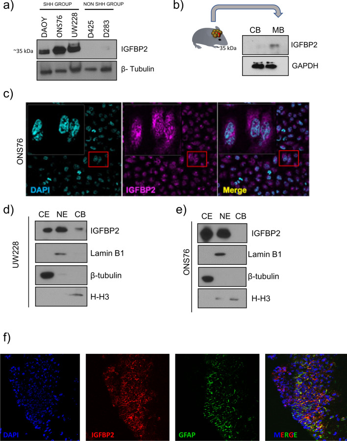 IGFBP2 promotes proliferation and cell migration through STAT3 signaling in Sonic hedgehog medulloblastoma.