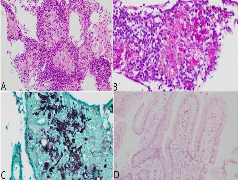 [Whipple's disease with multiple presentation in a rheumatologic patient].